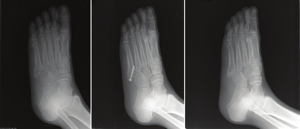 (E ) Lat eral rad iograph of bic ortic al c an nulat ed sc rew insertion. A B C Fi gure 2. 40 year old man with Jones fracture. (A) Initial foot oblique view with 9.1 mm displacement.