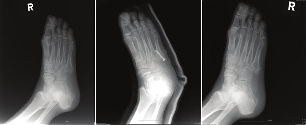 A B C Fi gure 3. 46 year old woman with delayed union of Jones fracture. (A) Initial foot oblique view with 2.4 mm displacement with marginal sclerosis.