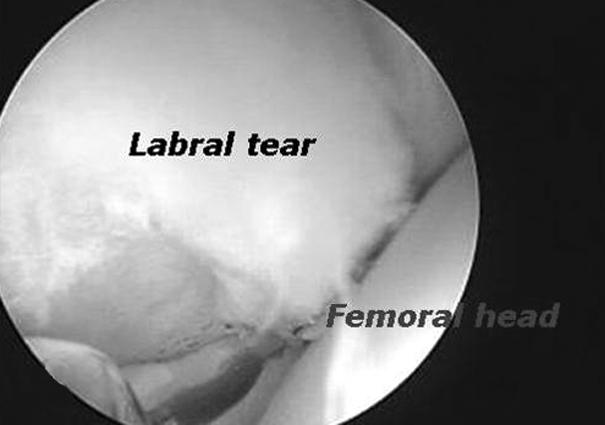 (A, B) Simple radiographs showed marked femoral head neck bump and acetabular retroversion. 써 관절내 술식을 용이하게 하였다.