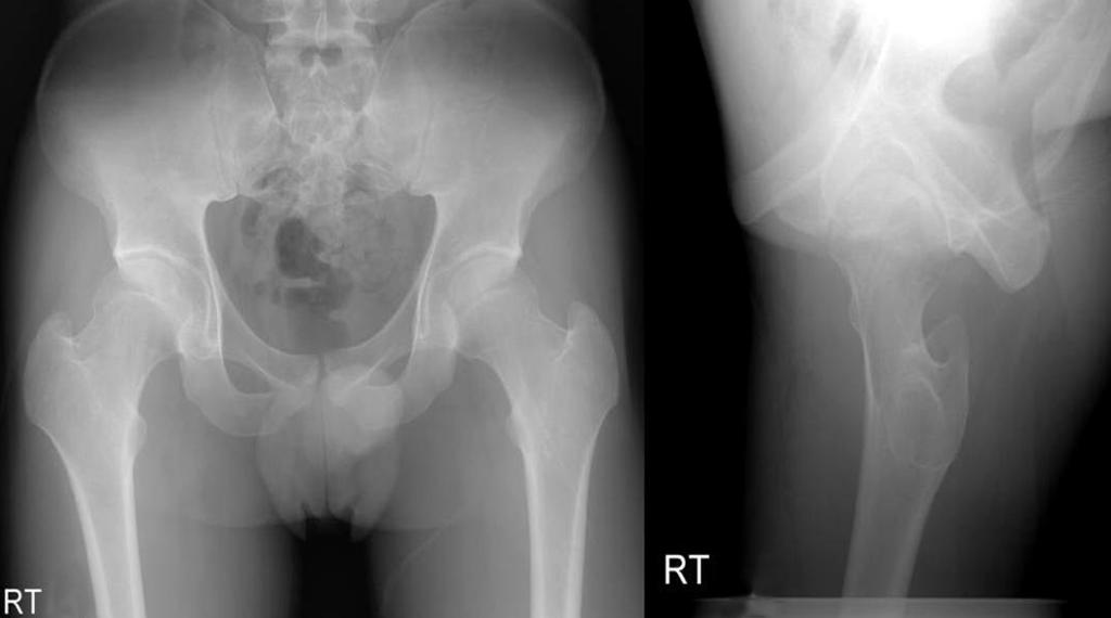 193 대퇴 비구 충돌의 관절경적 치료: 2-5년 추시 결과 Figure 6. 4 year follow-up radiographs of the same patient.