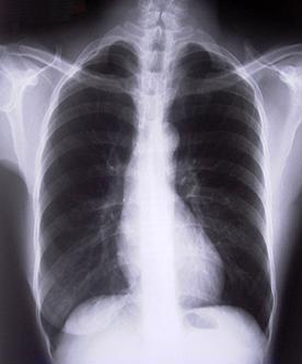 만성폐쇄성폐질환 (COPD) 병원전처치 -