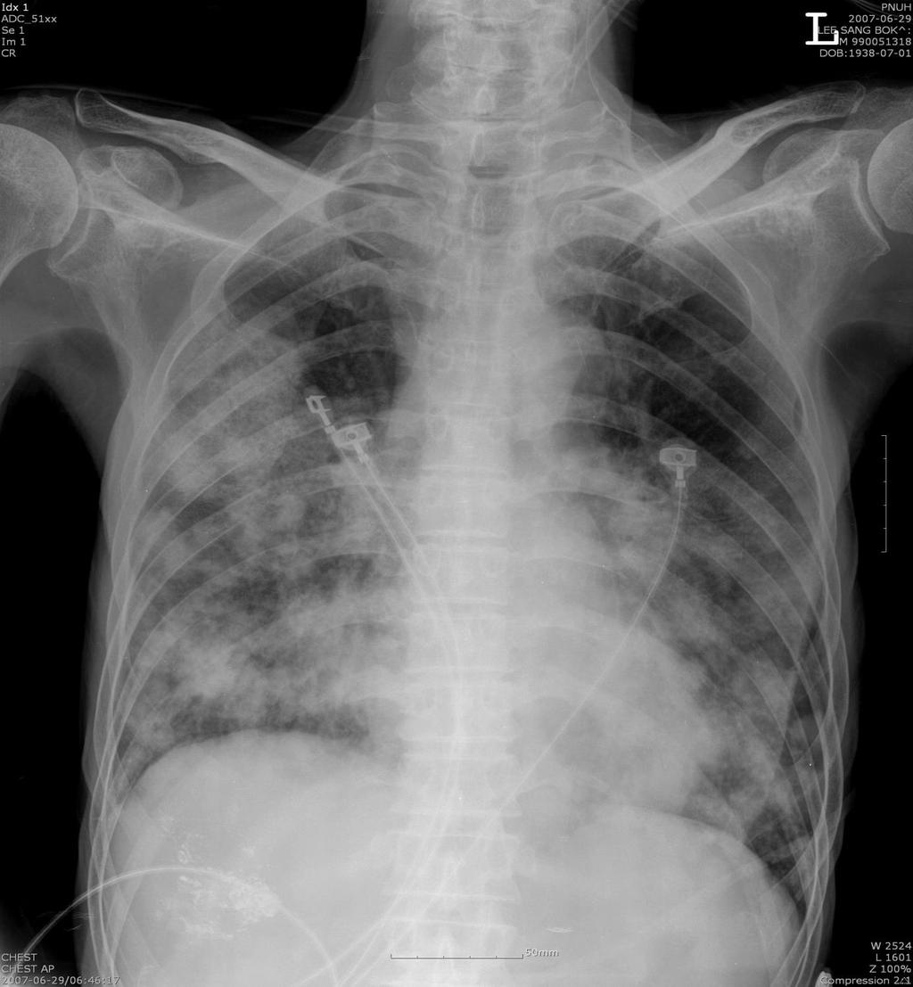 폐렴 (Pneumonia) 임상양상 - 기침, 호흡곤란, 가래, 발열, 흉통, 늑막자극증상, - 콧물, 미열,
