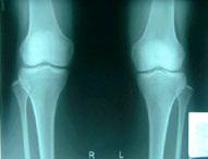 Clinical manifestations of OA Pain - localized, infero-medial side of knee - worsened with weight-bearing and