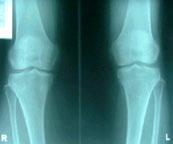 enlargement, crepitus on motion, joint limitation Anatomical causes of PAIN in OA 불분명.