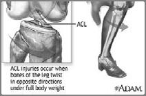 Neuromuscular in nature Hence, neuromuscular prevention program ACL Injury ACL injury mechanism ACL Injury paradigm shift 75% of