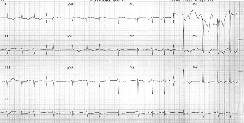 phenomenon F/U ECG after 48 Hours cqt interval was