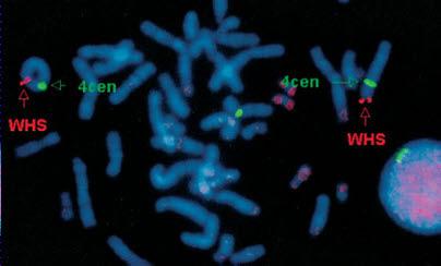 Fig. 4. FISH with subtelomeric 4p probe showing absence of 4p subtelomeric region on ring chromosome 4.