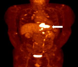 11 따라서, 기존의색소내시경과유사한결과를얻을수있는것으로보고되고있으며, 표재성식도암의병변관찰을향상시킬수있고, 암성병변에서동반되는혈관의변화를관찰하는데도 NBI가효과적일수있다 (Fig. 2B). 9 (3) High-resolution endoscopic imaging: 식도에발생하는선암의경우하부식도에호발하며바렛식도와관련이있는것으로알려져있다.