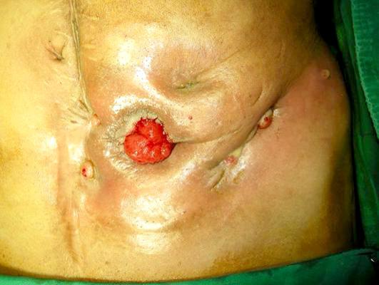wall defect with multiple enterocutaneous fistula in Crohn s
