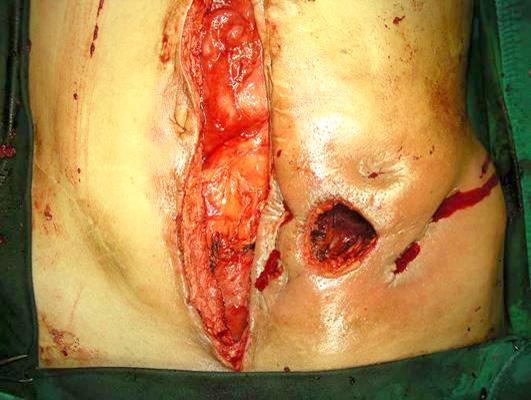 (A) Multiple enterocutaneous fistulas around ileostomy is