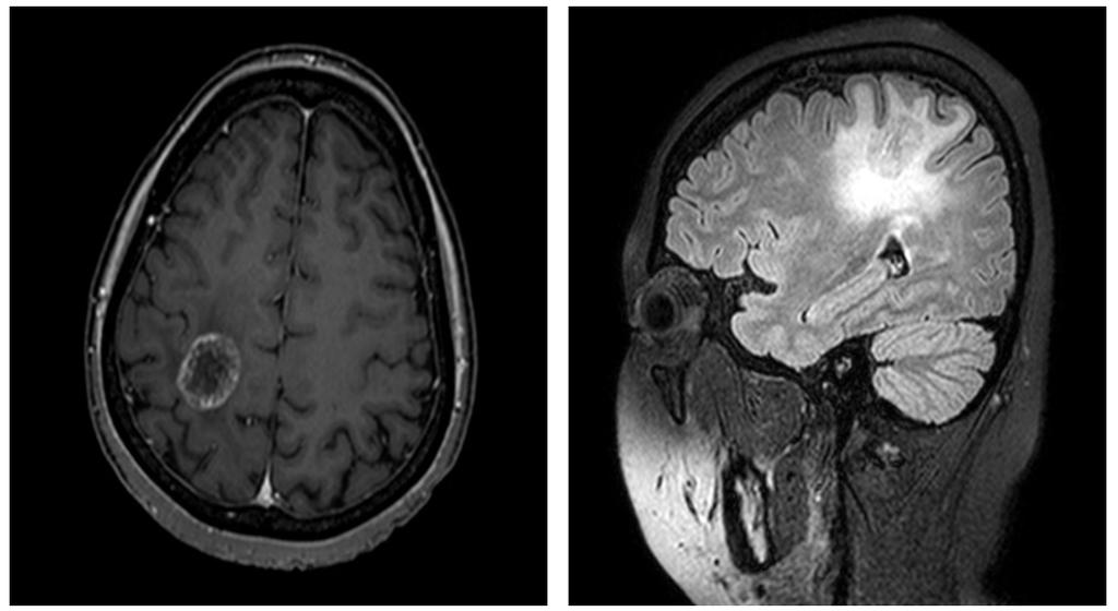 Korean J Clin Lab Sci. Vol. 50, No. 2, June 2018 213 Figure 2. This axial and sagittal MRI study showing a motor region in the right centro-parietal lobe. Figure 4.