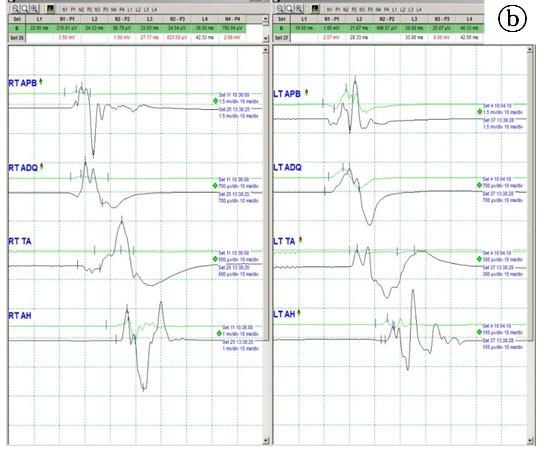 증례 3 전신 강직간대발작(generalized tonic-clonic seizures, GTC)을 주 증상으로 인해 내원한 환자에서 좌측 대뇌피질의 전 두-중심부에 종양이 발생하였고 구음장애(dysarthia) 와 우측 하지가 마비되어 자동차의 브레이크를 못 밟는 증상이 발생 하 였고 구음장애가 악화되어 종양제거를 위해 내원한 환자였다 (Figure