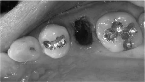 5. Radiograph taken after Implant OP of the case 1. Fig. 3.