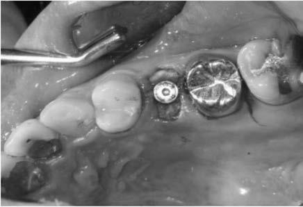 Radiograph of 20 Months after final restoration delivery of the case 1.