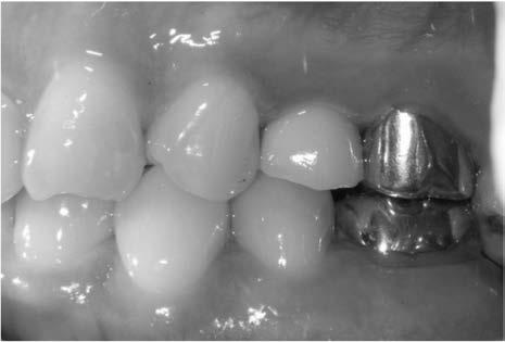 Intraoral photograph taken after Implant placement & GBR of the case 2.