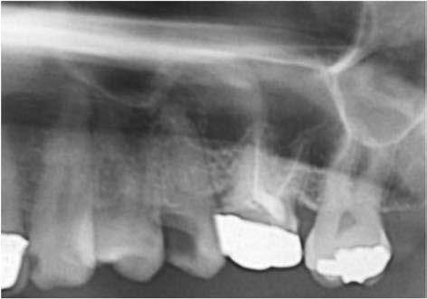 Radiograph taken after Implant OP of the case 2. Fig. 9.