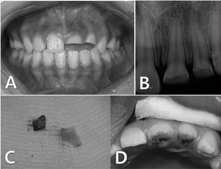 (A) #21, 22 Crown-root fracture, (B) Initial periapical x-ray view, (C) Fractured tooth fragments, (D) Access opening and pulp extirpation. Fig. 2. Procedure of intra-alveolar transplantation.
