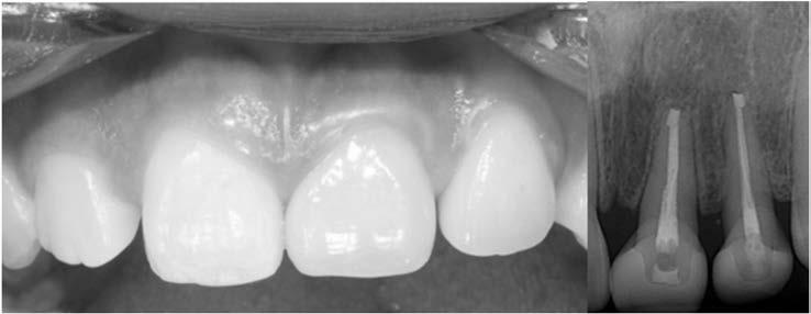 Jung KH, et al: Intra-alveolar transplantation for crown-root fractured anterior maxillary tooth 25 Fig. 6. Intra-oral photo and X-ray view of #21, 22 after 6 months intra-alveolar transplantation.
