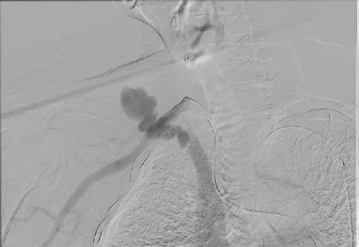한혈관조영술에서우측쇄골하동맥의중간부위에서가성동맥류가관찰되었으며동정맥루를통해상대정맥이조영되는양상이관찰되었다 (Fig 3). 가성동맥류를확인후우측대퇴동맥을통해카테터를진입시켜우측쇄골하동정맥루에 11 50 mm 크기의 Gore Viabahn Endoprosthesis (W.L.