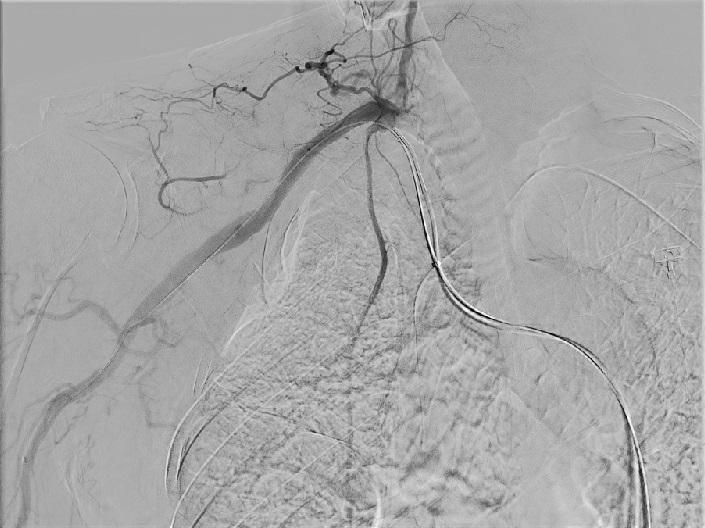 Pre-operative arteriogram showed the pseudoaneurysm of right subclavian artery with fistulous tract. Fig. 4.