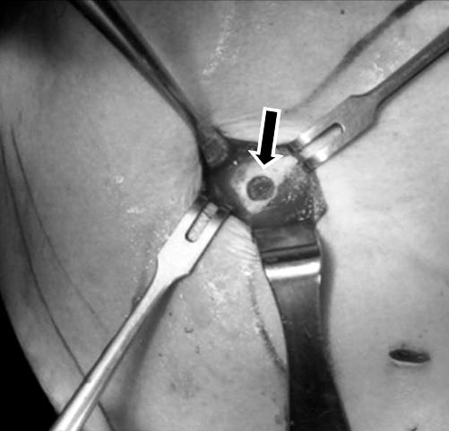 임시고정을 위한 K-wire는 견봉 쇄골 관절의 견 고한 고정을 위해 적절한 길이로 절단하여 남겨둔 후 수술 313 후 2주째 제거하였다.
