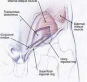 incompetency posterior abdominal wall 이손상되기때문에이학적검사에서 inguinal hernia 가관찰되지않습니다 2. Sports Hernia 스포츠탈장 3.