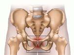 Posterior abdominal wall weakness- thinning or tearing X-ray, CT, bone scans, MRI : 다른감별진단에더도움이됨 Rx: Rest Groin