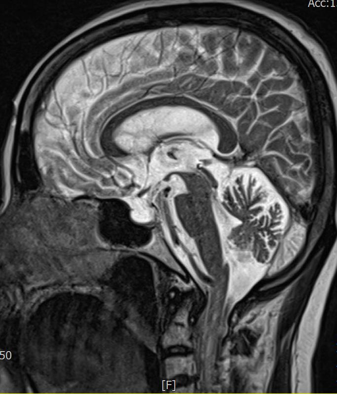 9. 현병력본환자는 2012년경부터서서히발생한보행장애증상으로 2015년 5월말경 병원신경과에서뇌자기공명영상 (brain magnetic resonance imaging, brain MRI) 촬영후 MSA-C 진단을받았다. 그후약물치료를지속적으로하였으나점차증상이악화되어 2015년 8월 18일경본원으로입원하였다. 10.