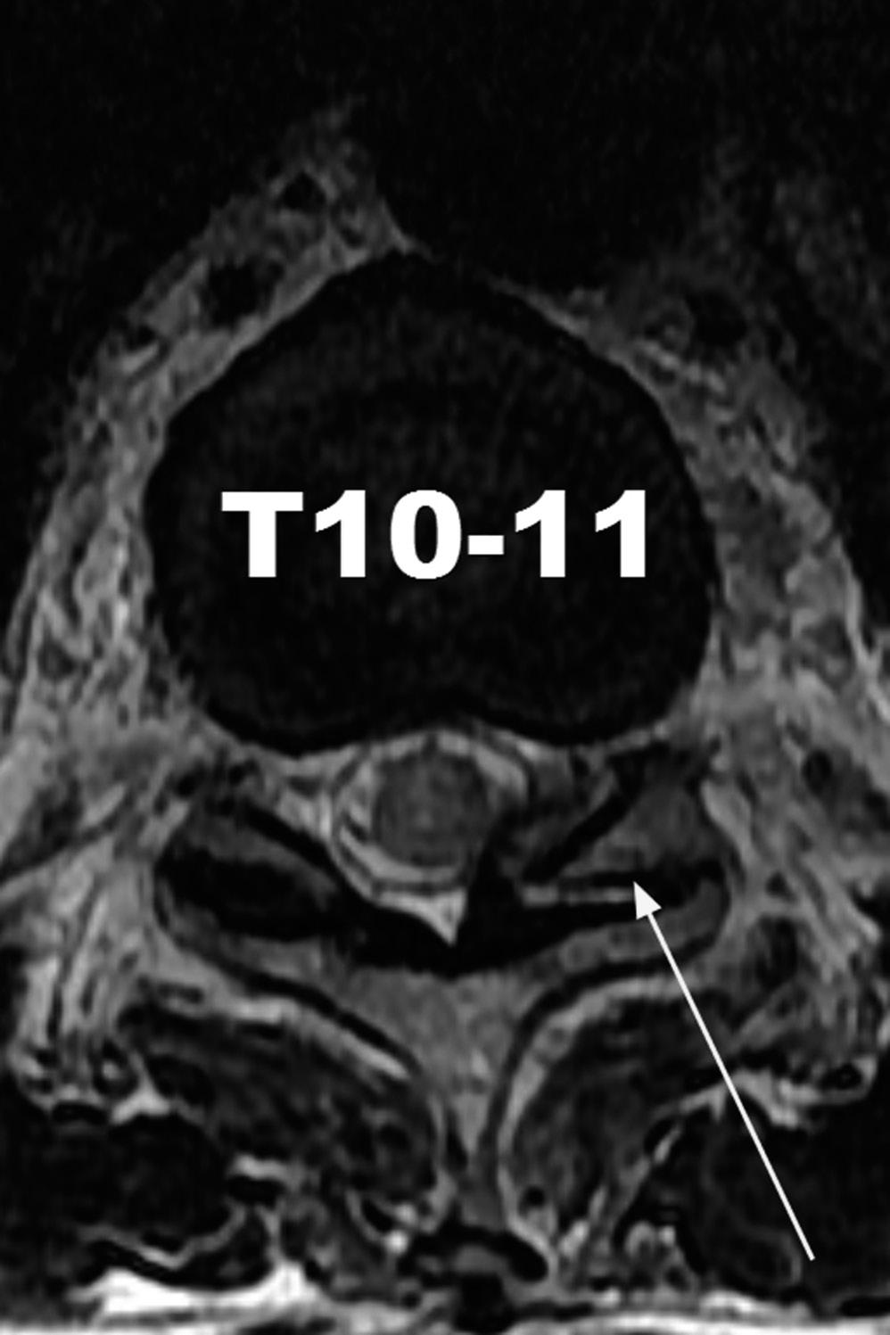 Showing T11 body and left pedicle, L2 body fracture 기저질환없이건강했던 62세남자환자가 3층높이에서낙상한후흉-요추부의통증및하지의마비증상이발생하여내원하였다.