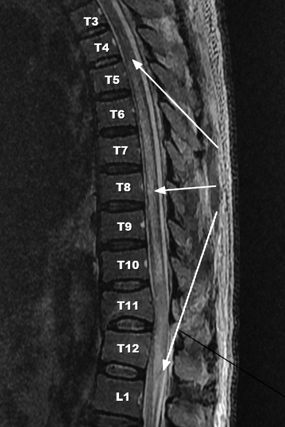 Journal of Korean Society of Spine Surgery Subacute Delayed Ascending Myelopathy after Low Spinal Cord Injury 족간대성경련도나타나지않았다.