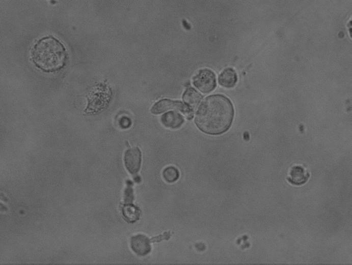12 Seon-Min Hong, et al. 된 정상세포도 죽이는 능력을 가진다. 그리고 형태적으 로는 큰 과립림프구이며, T세포의 표지인자나 표면단백 질인 Ig이 존재하지 않는다. 세포의 종양에 대한 세포 독성은 vitro상태에서 인터루킨-2 (IL-2)와 인터페론-α와 같은 세포조절물질이 존재하면 증가하게 된다.