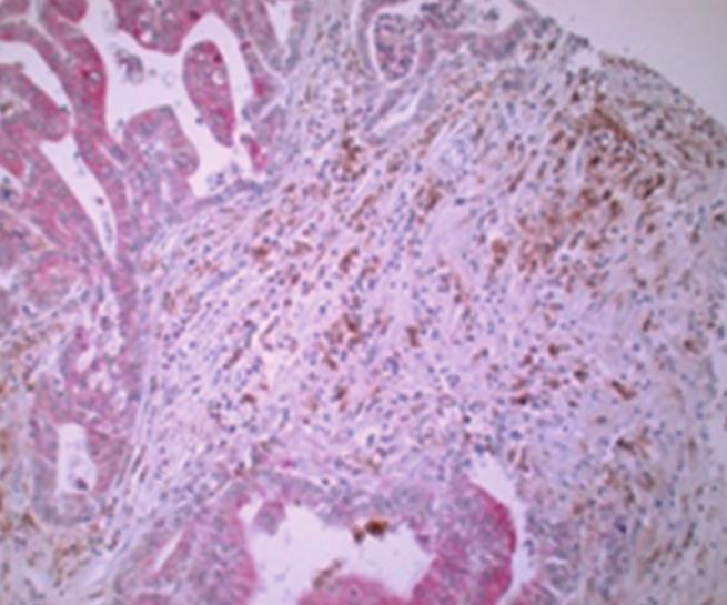 (A) Immunohistochemical analysis showed elevated levels of macrophages (CD68high,