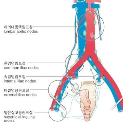 체순환 Internal rectal venous plexus 를이루어서로연결, 부위에따라위와같은정맥으로나감 Internal Hemorroid (anorectal line 위 )- painless External Hemorroid (anorectal line 아래 )- painful
