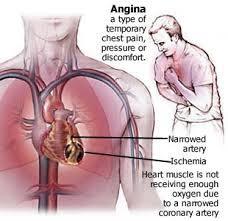 협심증 (angina pectoris) 심근경색
