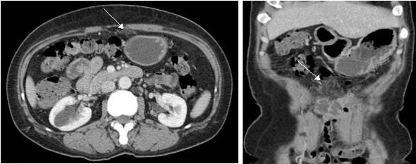 Figure 2. Follow-up () axial and () coronal contrast-enhanced CT scan performed 14 days after discharge demonstrated the decrease of the infarct area (arrow). Figure 3.