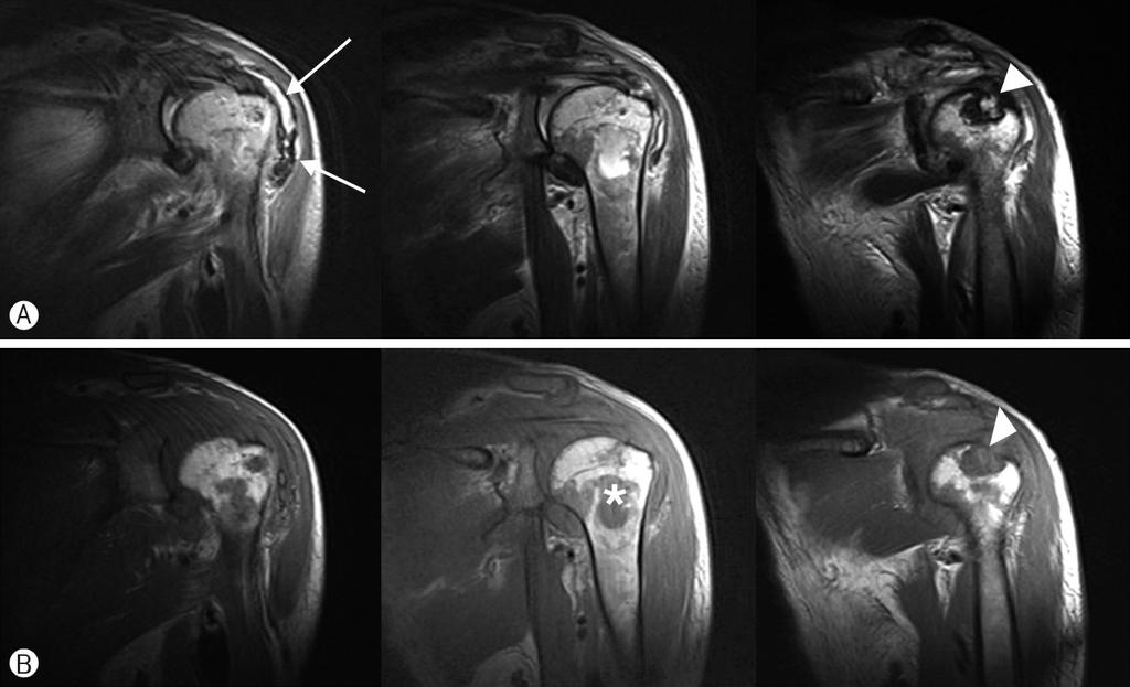 Soo Yeon Park, et al: Candida Arthritis on HD Patient Fig. 1. Noncontrast magnetic resonance imaging of left shoulder.