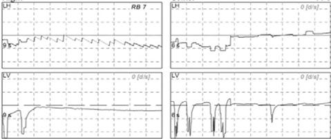 And left beating left torsional nystagmus (60 /sec) was found on the left Dix-Hallpike test. This nystagmus was reversed by sitting up, implying left posterior canal BPPV.