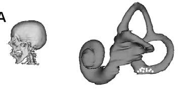 서명환외 A B C D Fig. 3. Simulation of left posterior canalith during head roll test.