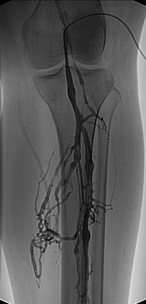 thrombus with obstruction in the popliteal and tibial veins. B.