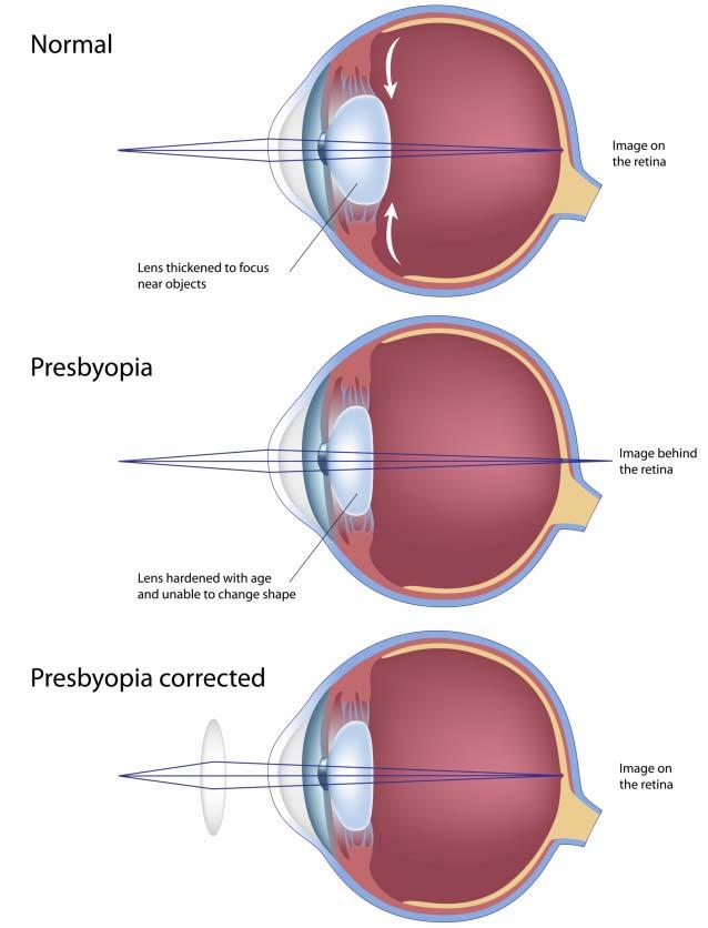 7 노화로인한시각의변화 노안 (Presbyopia) 노안 먼거리는안경의도움없이도잘보이지만나이가들면서가까운곳만흐리게보이는것 노안의원인 모양체의근육수축력이떨어짐