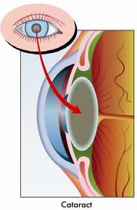눈의수정체가흐려져시력장애를일으키는질환 위험요인 : 고령,