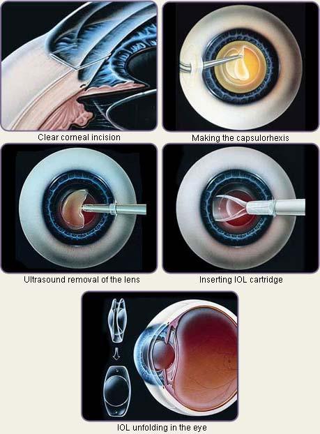 7 노화로인한시각의변화 백내장 (Cataract) 03 치료