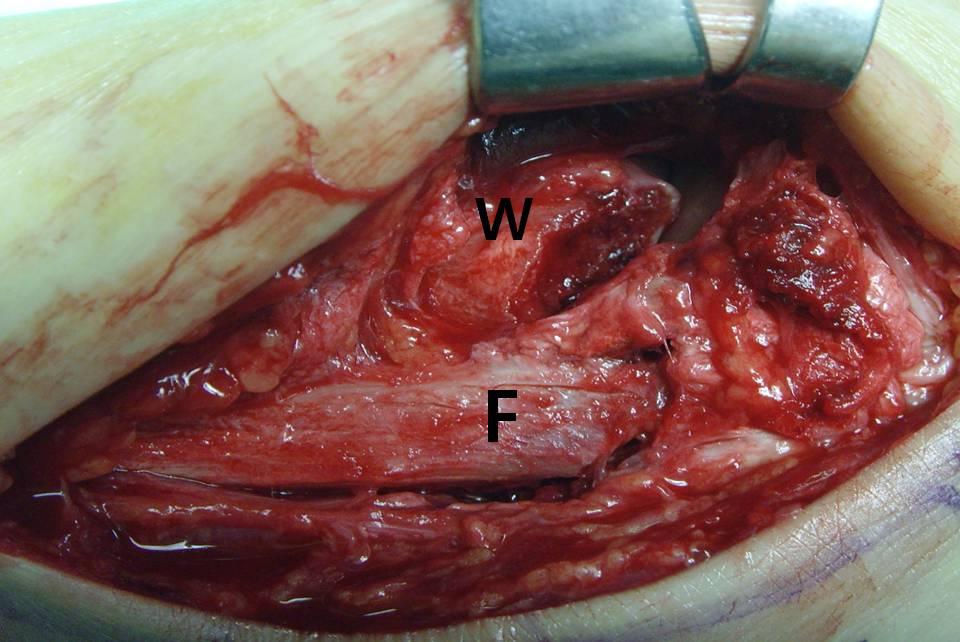 Type I Type II Type III Type IV Figure 6. A modified Wagstaffe classification of anterior inferior tibiofibular ligament avulsion fracture. Figure 4.