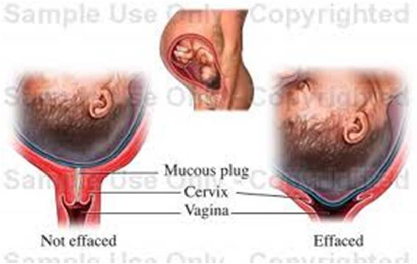 분만 분만진통의임상적발현 이슬 (show) 내진을하지않은상태에서임신중자궁경관에있던점액진 (mucus