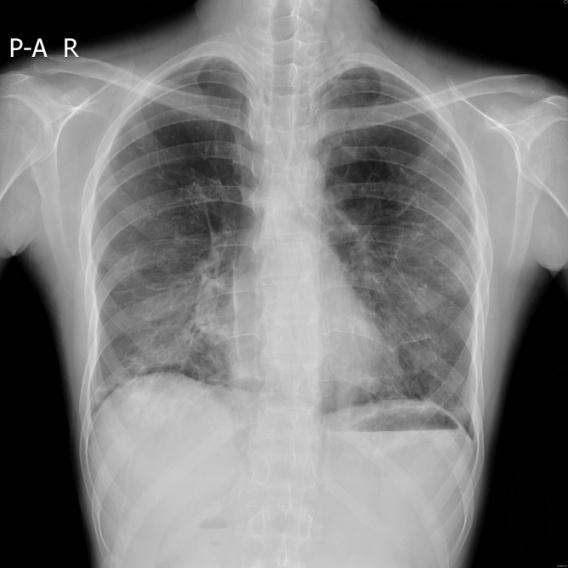 - The Korean Journal of Medicine: Vol. 77, No. 6, 2009 - Table 1. Results of pulmonary function tests Measurement Before the onset of dyspnea After the onset of dyspnea FVC (L) 4.05 (69%) 1.