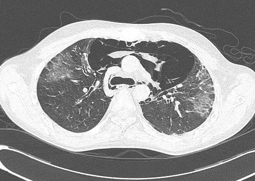 - Ho Sup Lee, et al. Pneumomediastinum combined with chronic graft-versus-host disease - A B C D Figure 2.