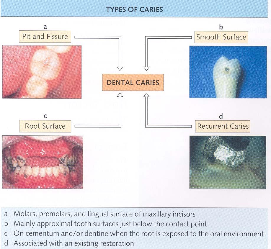 치아우식증의종류
