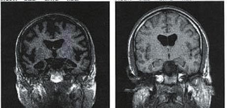 치 매 4) 뇌영상검사치매의원인을찾기위해뇌영상검사를시행합니다.