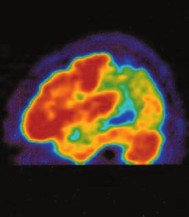 뇌수두증등뇌의구조적이상소견들을확인할수있습니다. 근래에는 CT보다해상도가높은 MRI가널리사용되고있습니다. 그러나 MRI 단독으로모든치매를진단할수있는것은아닙니다.