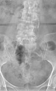 tissue) 진단적검사 Plain radiographs (X-ray) 1) 척추의정렬및구조 (Alignment and anatomy) 
